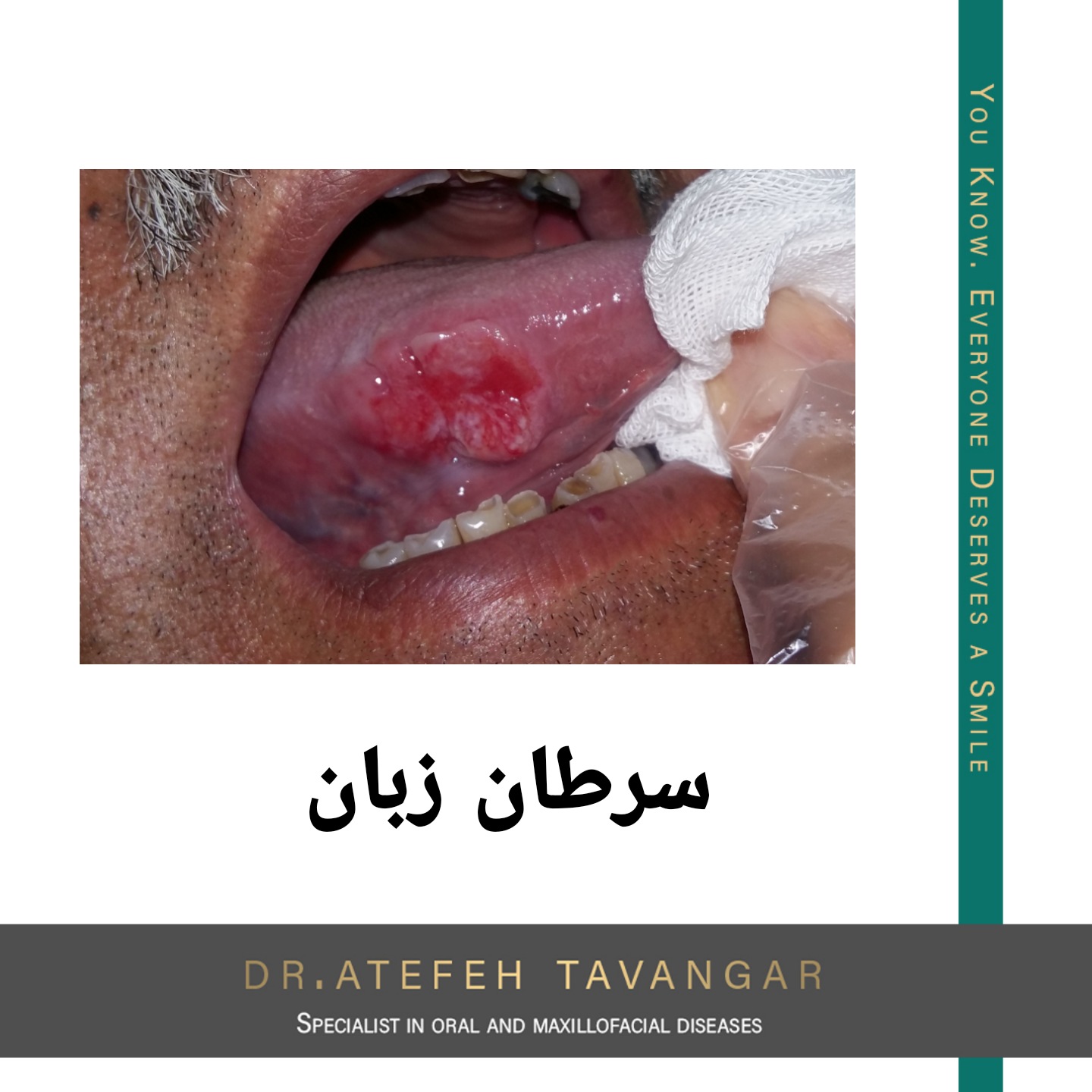 عکس ضایعات زیر زبان